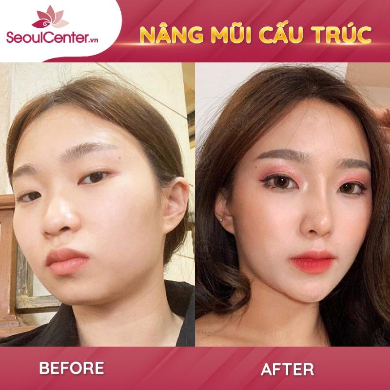 Kết quả khách hàng sau khi nâng mũi cấu trúc tại Seoul Center