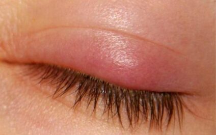 Chườm đá lạnh giúp mí mắt giảm sưng và kích thích lưu thông máu