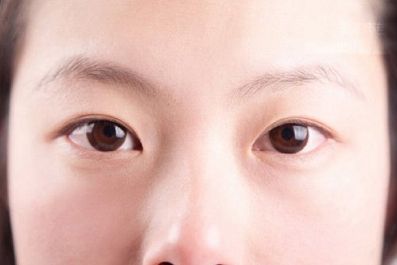 Mắt mí lót không được xem là đẹp