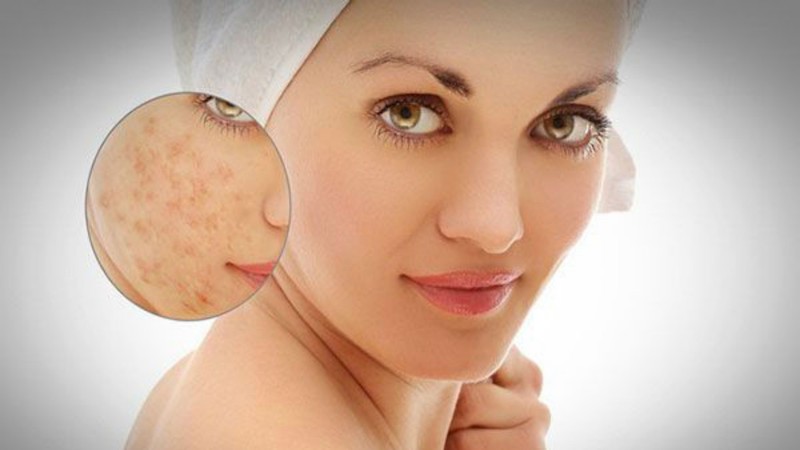 Bột nghệ giúp trị sẹo hiệu quả