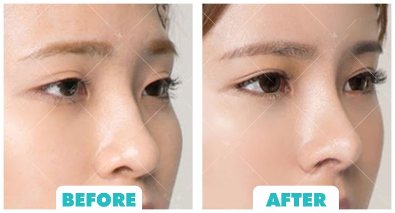 Sau khoảng 1 tháng phẫu thuật, vết thương mới thật sự hồi phục hoàn toàn
