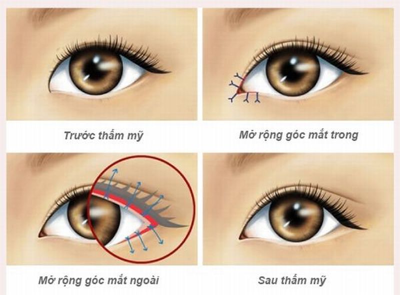 Mở rộng góc mắt trong và góc mắt ngoài là phương pháp phổ biến hiện nay
