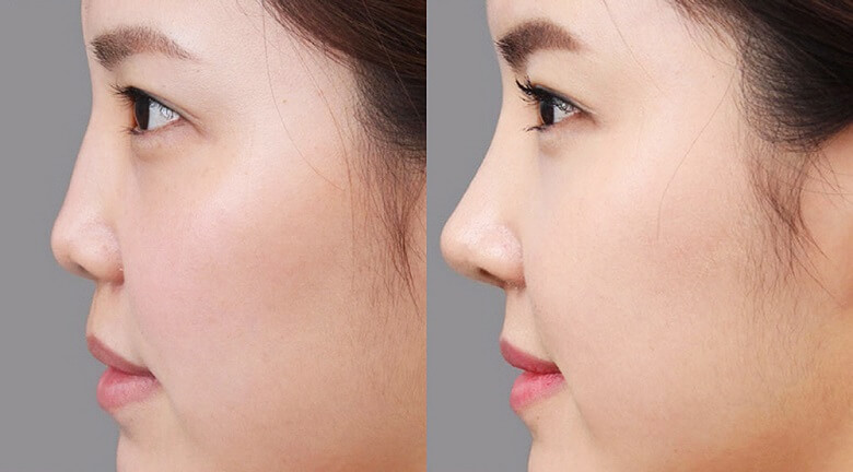Chiếc mũi nâng thành công tạo nên góc nghiêng “thần thánh”
