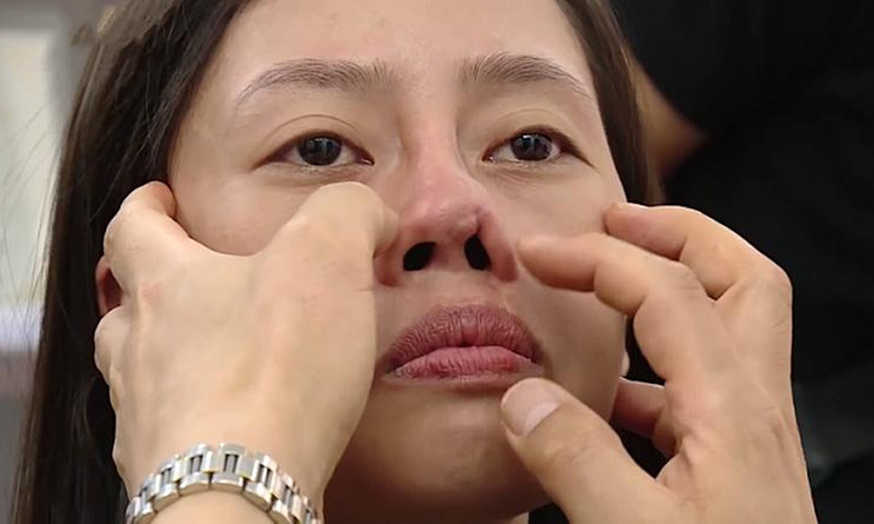Nguyên nhân bẩm sinh là lý do phổ biến gây mũi gồ hiện nay Nguyên nhân bẩm sinh là lý do phổ biến gây mũi gồ hiện nay