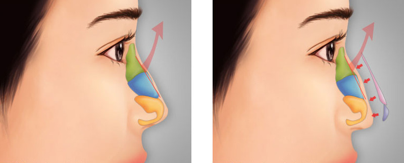 Lựa chọn cơ sở y tế không uy tín có thể làm ca phẫu thuật nâng mũi không thành công Lựa chọn cơ sở y tế không uy tín có thể làm ca phẫu thuật nâng mũi không thành công