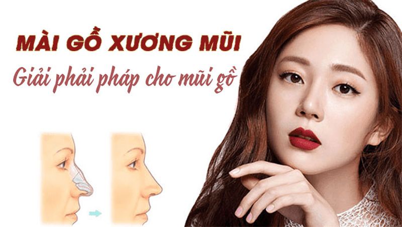 Kỹ thuật mài xương áp dụng cho các trường hợp gồ nhẹ Kỹ thuật mài xương áp dụng cho các trường hợp gồ nhẹ