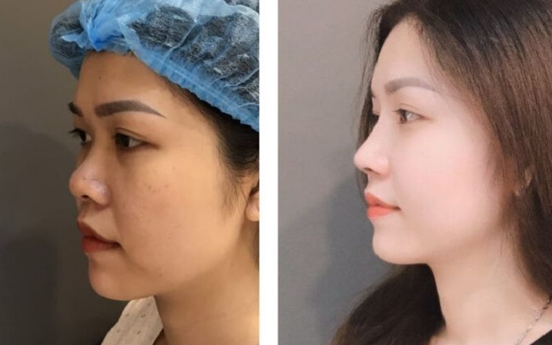 Khắc phục được chiếc mũi xấu chỉ trong thời gian ngắn