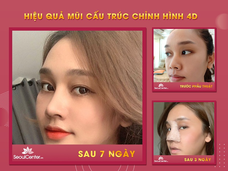 Khách hàng sở hữu dáng mũi hoàn hảo hơn chỉ sau 1 tuần