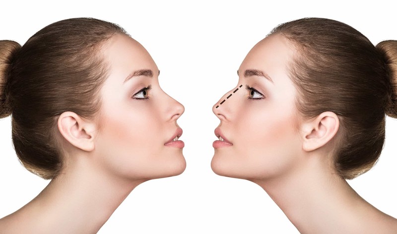 Nên điều chỉnh để có được dáng mũi đẹp hơn