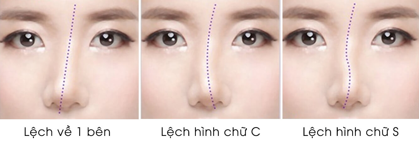 Các dáng mũi lệch thường gặp