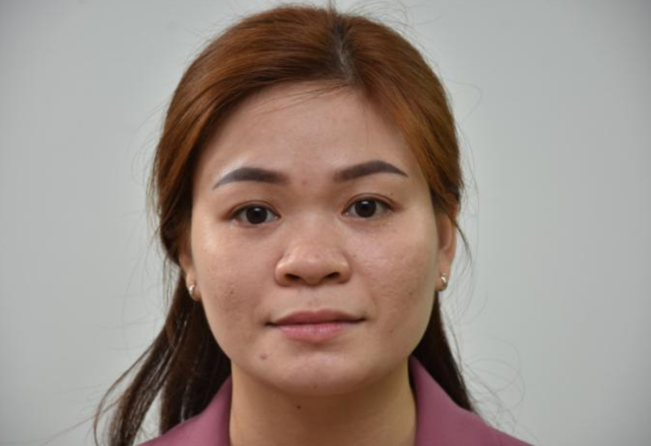 Dáng mũi tẹt thường đi kèm với tình trạng mũi hếch, không có sống mũi, cánh mũi to bè