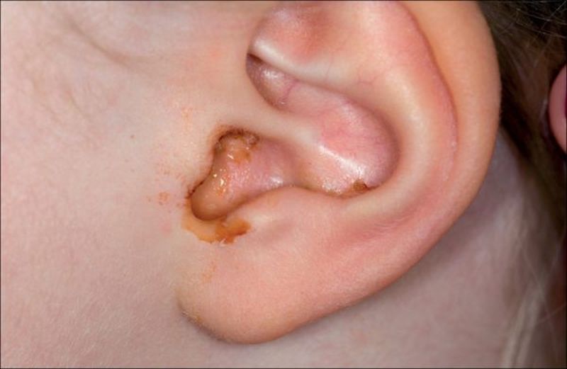 Nhiễm trùng tai là một trong những nguyên nhân gây mụn ở tai nghiêm trọng