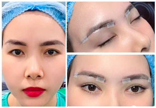 Kết quả nâng cung mày hoàn hảo, không đau, không sẹo xấu tại các cơ sở thẩm mỹ uy tín