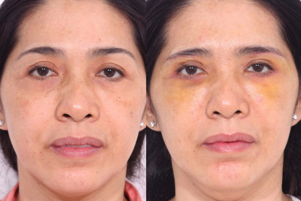 Nâng cung mày khoảng 5 – 7 ngày là hết sưng, đau