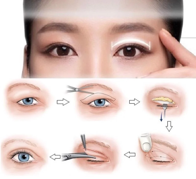 Nâng cung chân mày can thiệp trực tiếp vào phần da thừa trên hay dưới lông mày