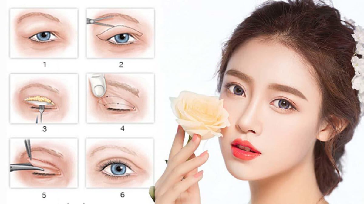 Cắt mí tác động trực tiếp lên phần nếp mí mắt Cắt mí tác động trực tiếp lên phần nếp mí mắt