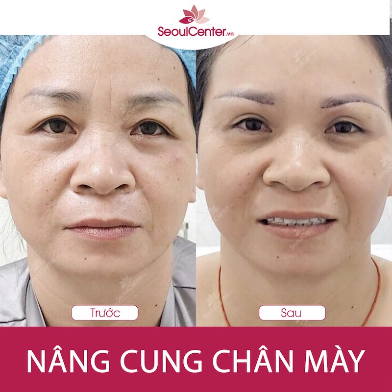 Kết quả sau khi nâng cung chân mày tại Seoul Center