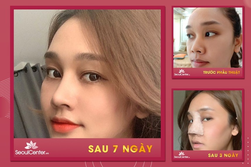 Dáng mũi hài hòa với gương mặt và đẹp như sao Hàn