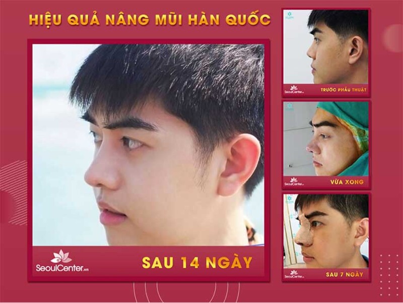 Kết quả đẹp tự nhiên chỉ sau 2 tuần