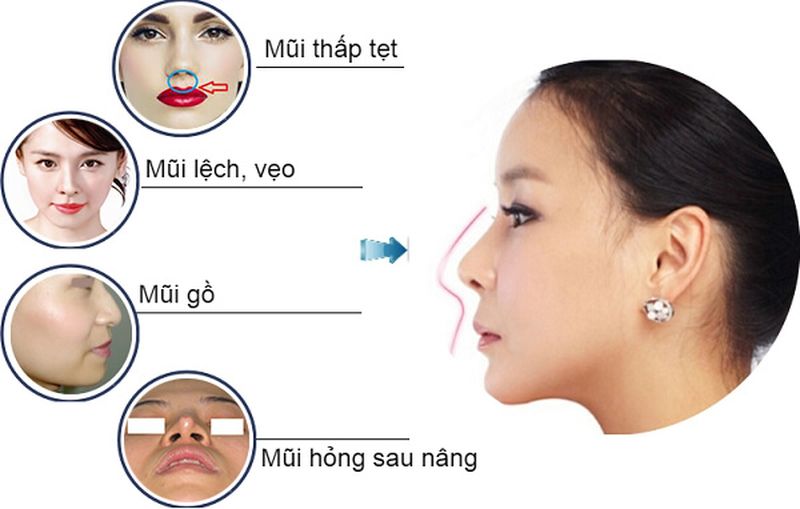 Mũi có quá nhiều khiếm khuyết cũng làm tăng chi phí phẫu thuật nâng mũi