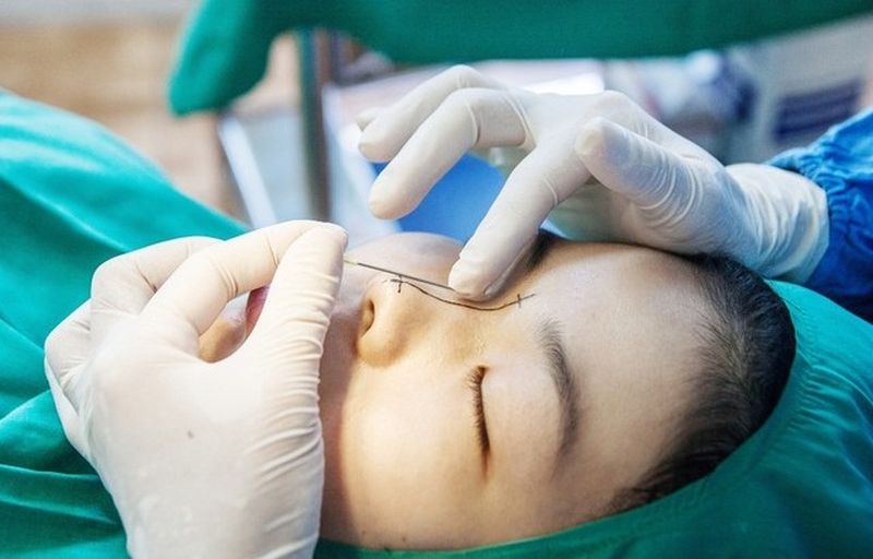 Nâng mũi với sụn tự thân chỉ đau ở một số giai đoạn nhất định trong ngưỡng cơ thể có thể chịu đựng được