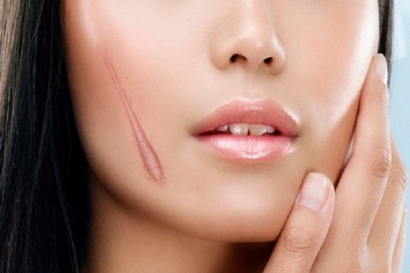Cơ địa sẹo lồi sẽ khiến cho việc nâng mũi gặp khó khăn