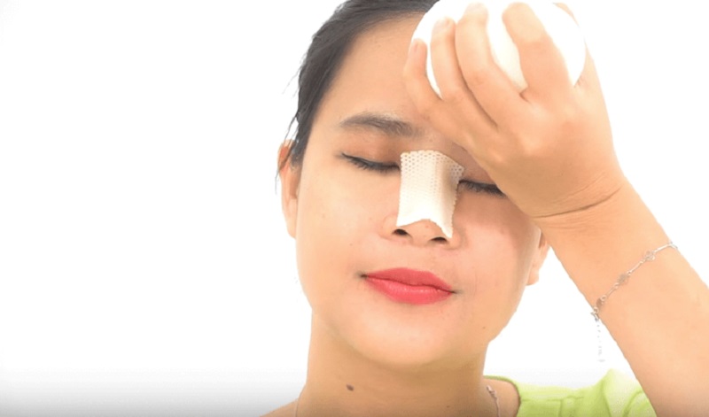 Chế độ chăm sóc tốt sau nâng mũi tránh được sẹo lồi