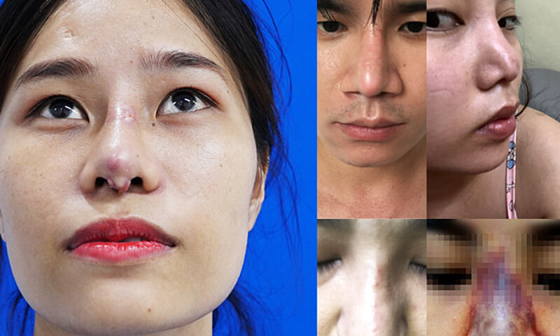 Nâng mũi bọc sụn giá bao nhiêu
