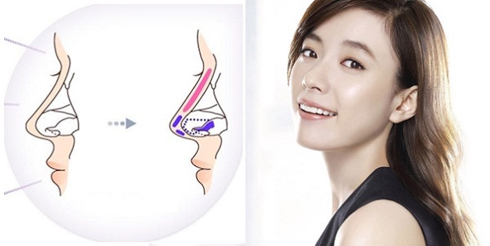 Nâng mũi bọc sụn megaderm có thực sự tốt không? Nên thực hiện ở đâu?