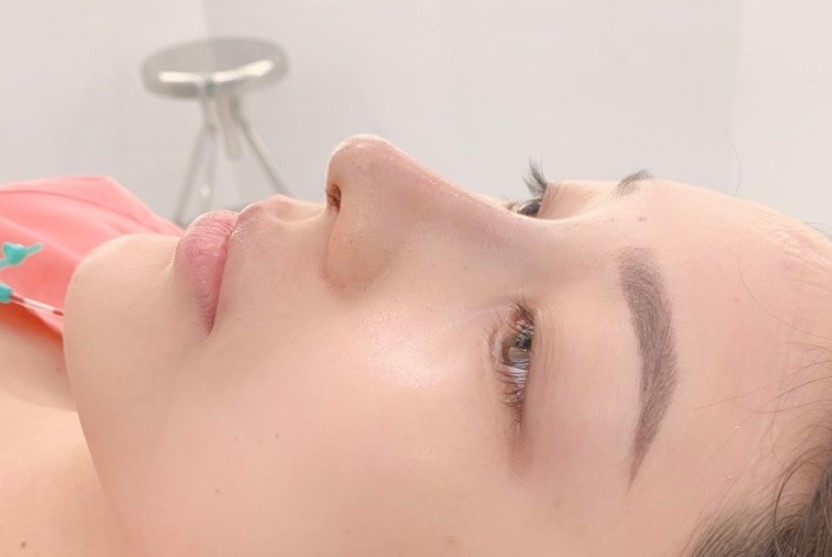 Sụn Surgiform có lỗ nhỏ li ti cho máu lưu thông nên ít bị sưng bầm, biến chứng