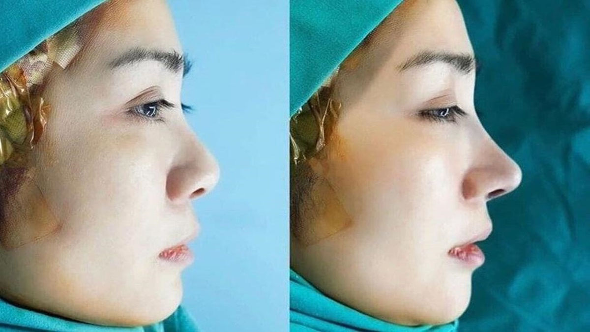 Sống mũi cao, đầu mũi được nâng lên nhưng vẫn tự nhiên nhờ hai loại sụn
