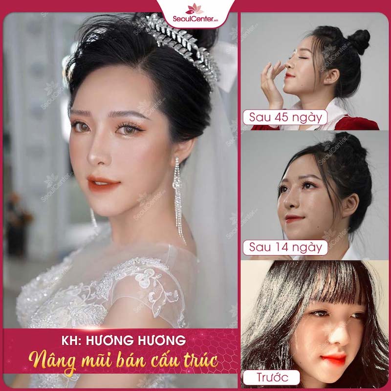 Sau 45 ngày với quy trình chăm sóc hậu phẫu chuẩn theo đúng hướng dẫn của nhân viên y tế, bạn Hương Hương đã sở hữu dáng mũi đẹp và rất cân đối