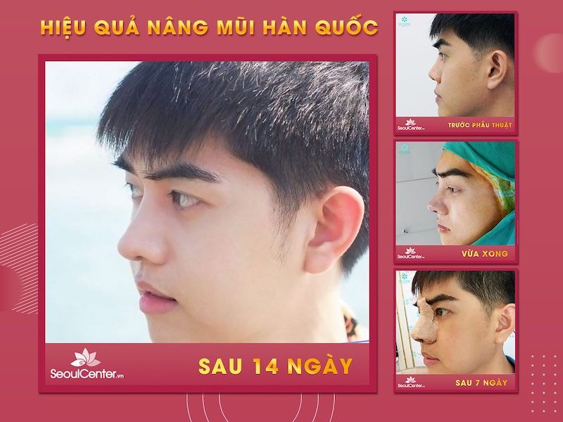 Chỉ mất thời gian hồi phục 14 ngày là chàng trai đã có thể tự hào về chiếc mũi cao, thẳng tắp của mình