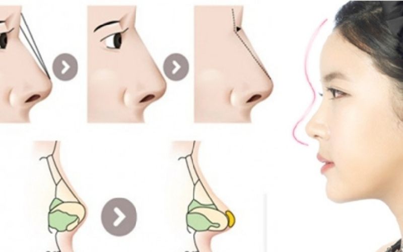Nâng mũi điêu khắc hiện đại mang tính thẩm cao