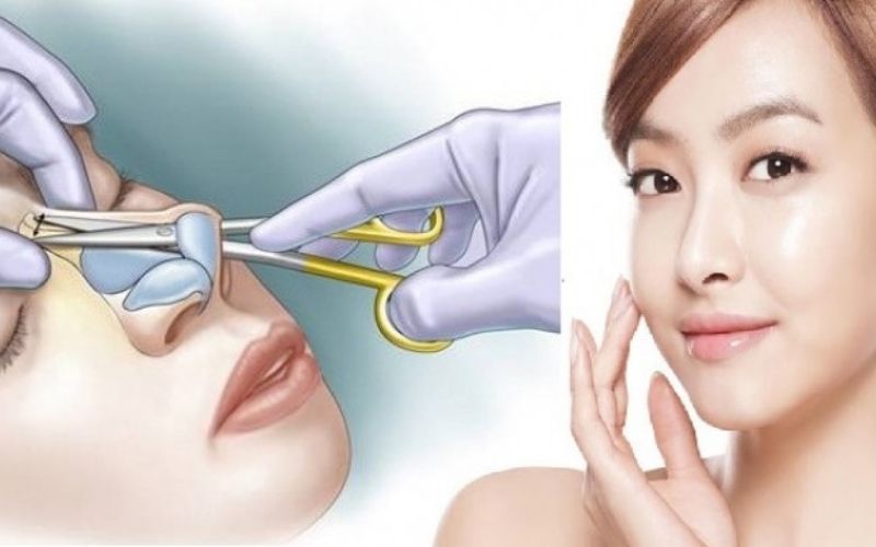 Công nghệ nâng mũi tiên tiến mang nhiều ưu điểm vượt trội