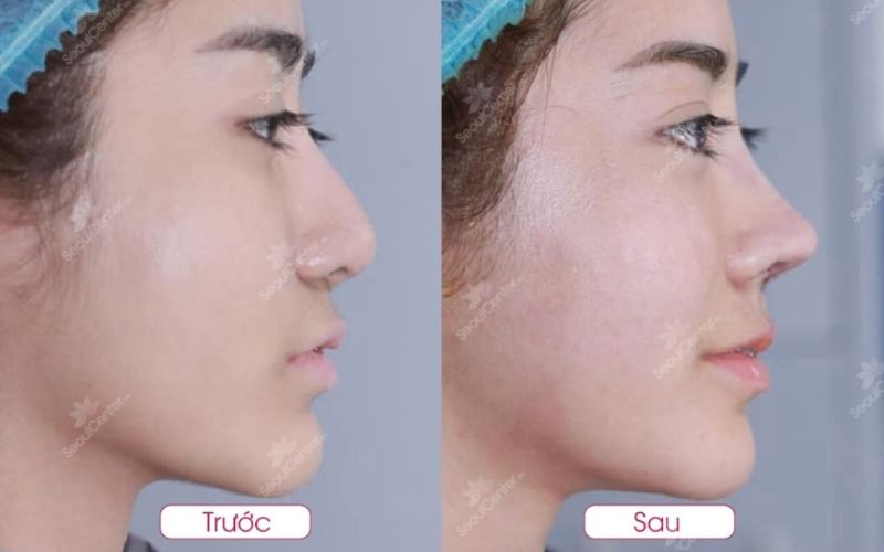 Seoul Center đã tạo ra vô số chiếc mũi đẹp cho khách hàng