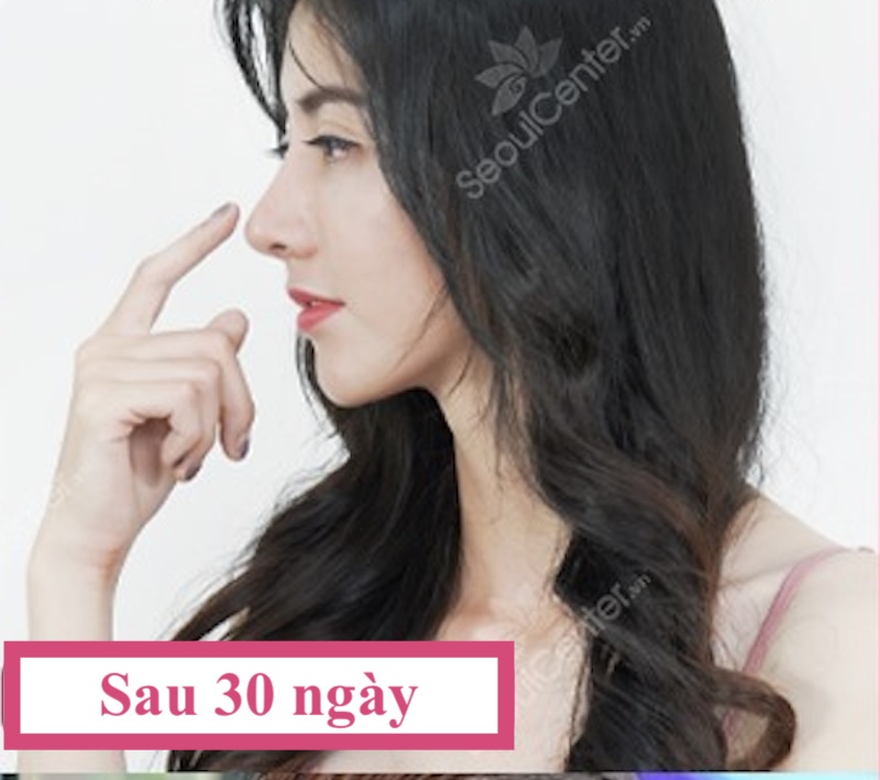 Đây là hình ảnh khách hàng 1 tháng sau khi nâng mũi tại Seoul Center