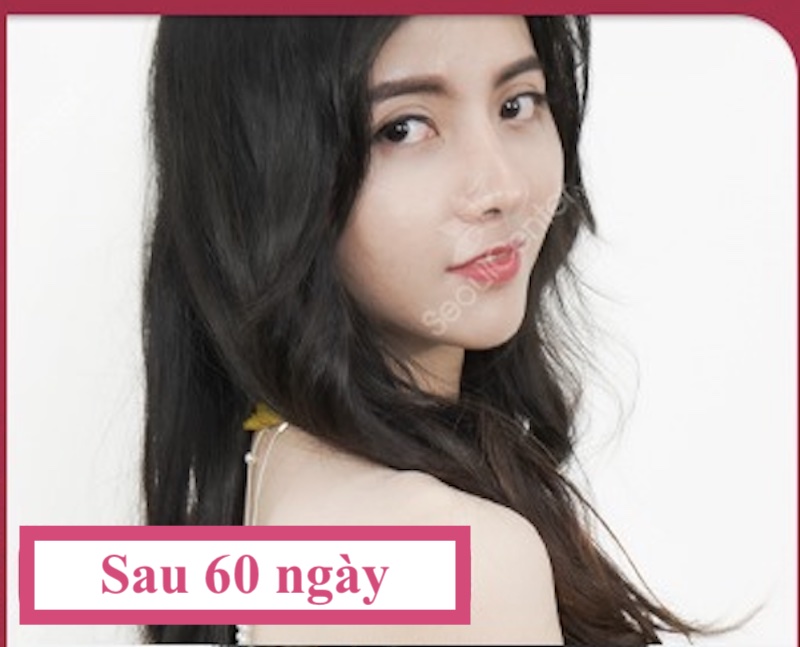 Đây là hình ảnh khách hàng 2 tháng sau khi nâng mũi tại Seoul Center