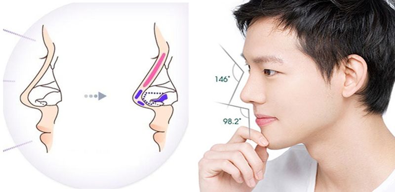 Phương án để cải thiện những khuyết điểm của chiếc mũi hiệu nhất là phẫu thuật nâng mũi