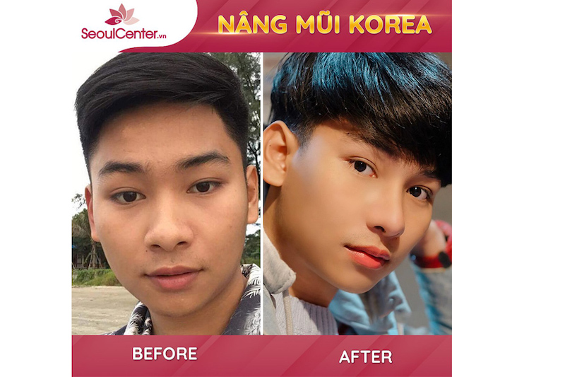 Dáng mũi sau khi hồi phục đã thon gọn và hài hòa hơn với khuôn mặt rất nhiều