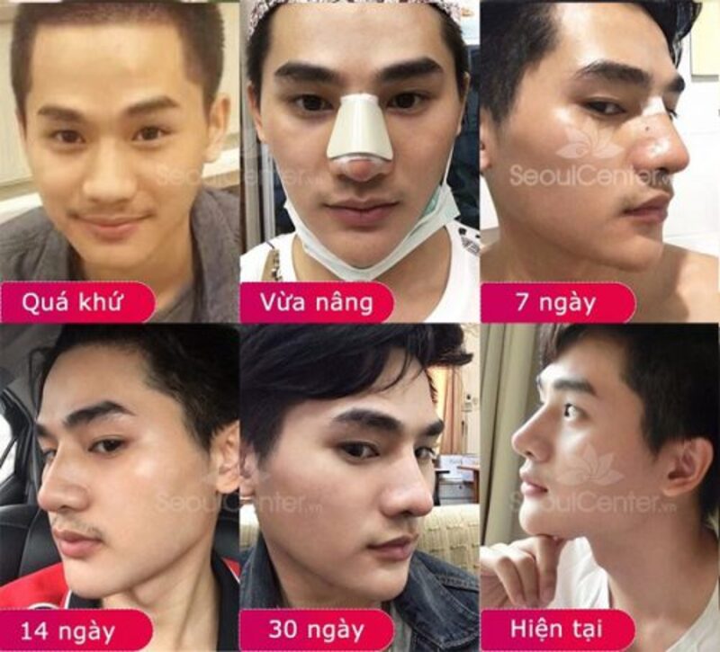 nâng mũi nam giới giá bao nhiêu