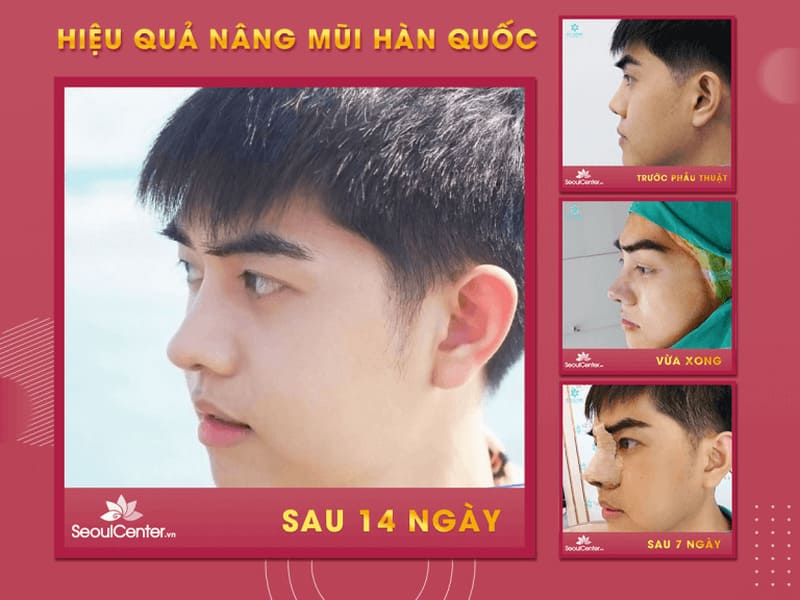 Phẫu thuật nâng mũi Hàn Quốc tại Seoul Center đem lại dáng mũi đẹp, cân đối với khuôn mặt sau 14 ngày hậu phẫu