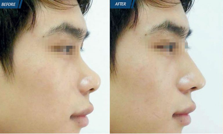 Phẫu thuật nâng mũi giúp khắc phục khuyết điểm mũi