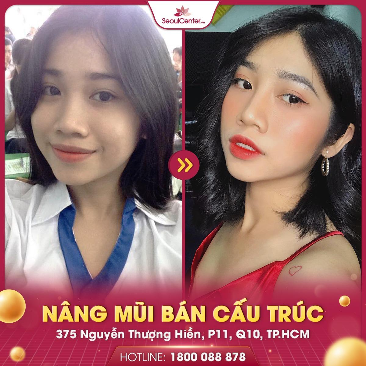 Khách hàng sau khi nâng mũi tại Seoul Center