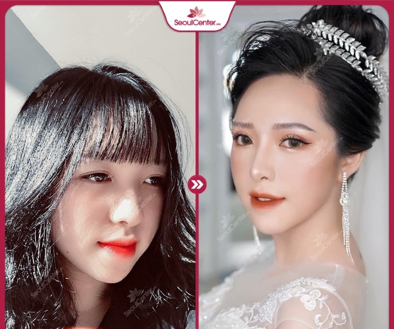 Hình ảnh khách hàng trước và sau nâng mũi tại Seoul Center