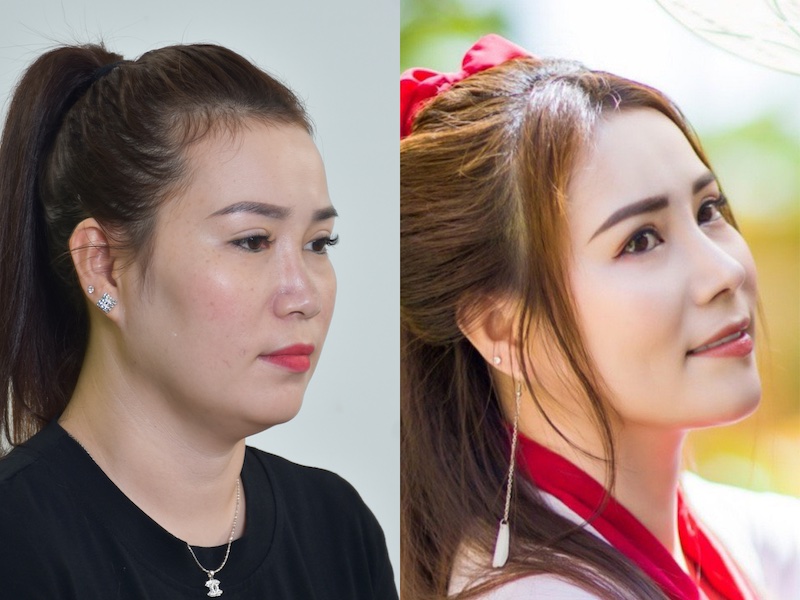 Đẹp dạng ngời sau khi sửa tướng mũi