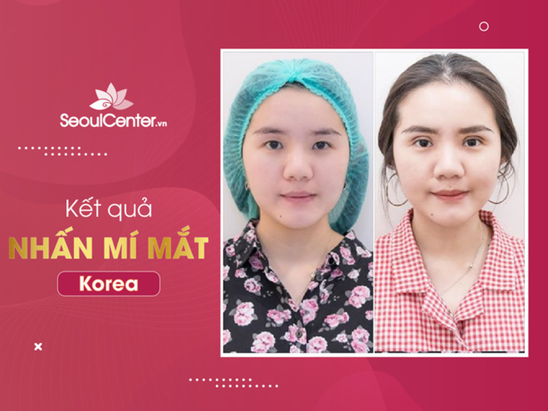 Nhấn mí mắt Hàn Quốc mang đến đôi mắt to tròn và gương mặt trẻ trung
