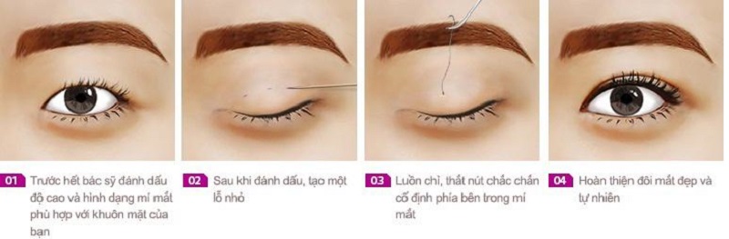 Kỹ thuật nhấn mí mắt kém an toàn dễ dẫn đến ảnh hưởng sau nhấn mí