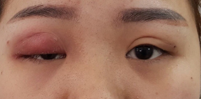 Mắt sau nhấn mí sưng bầm kéo dài nhiều ngày