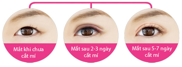 Cắt mí khoảng 5 – 7 ngày sẽ lành thương